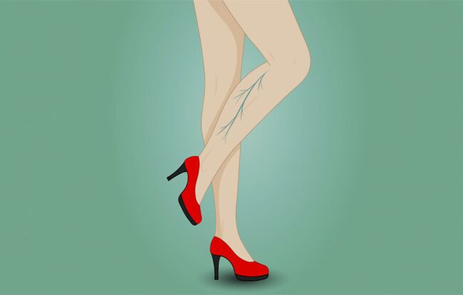 Varicose veins on the legs of women