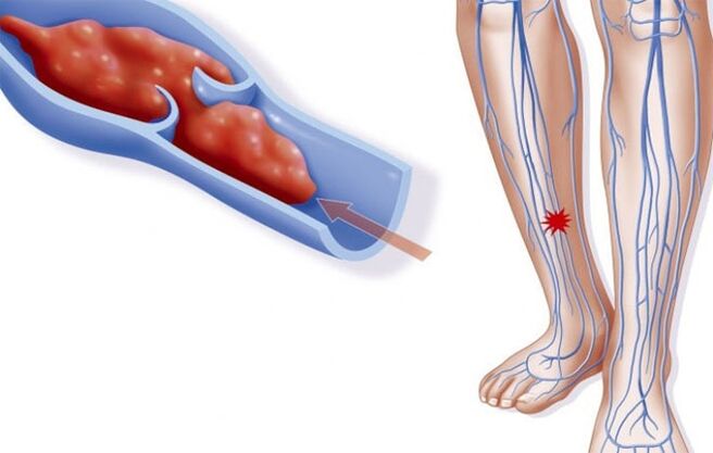Thromboflebitis