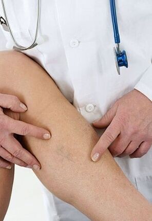 Dilated veins of the lower extremities