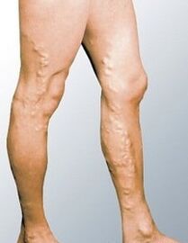 Varicose veins on men's legs