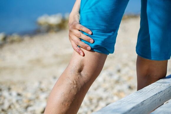 Excruciating pain in the legs with varicose veins