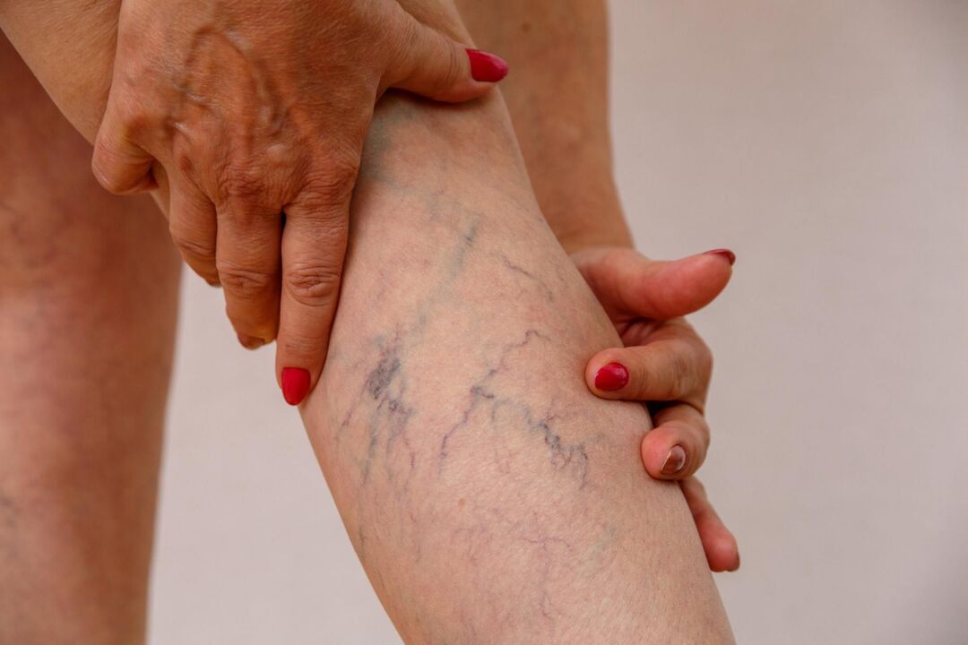 varicose veins on the legs