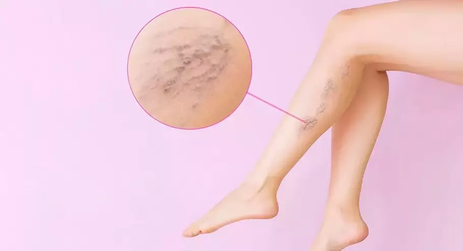 Curved bulging leg veins with varicose veins