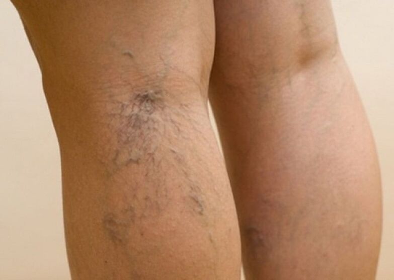 The beginning of the development of varicose veins on the legs